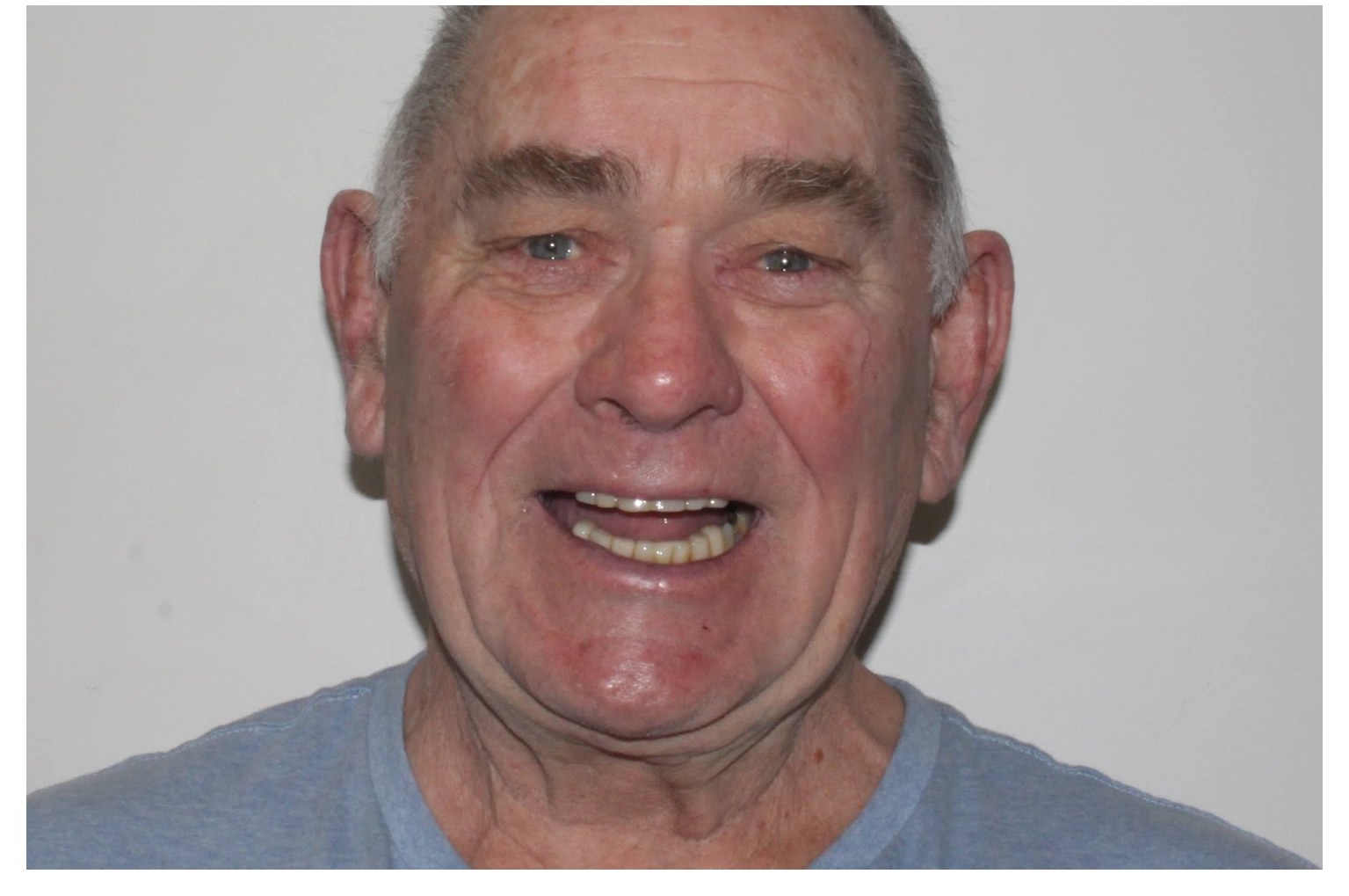 Patient smile after treatment
