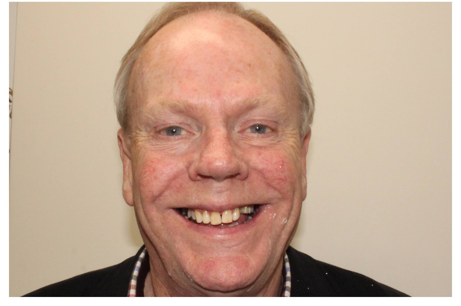 The same smile before treatment